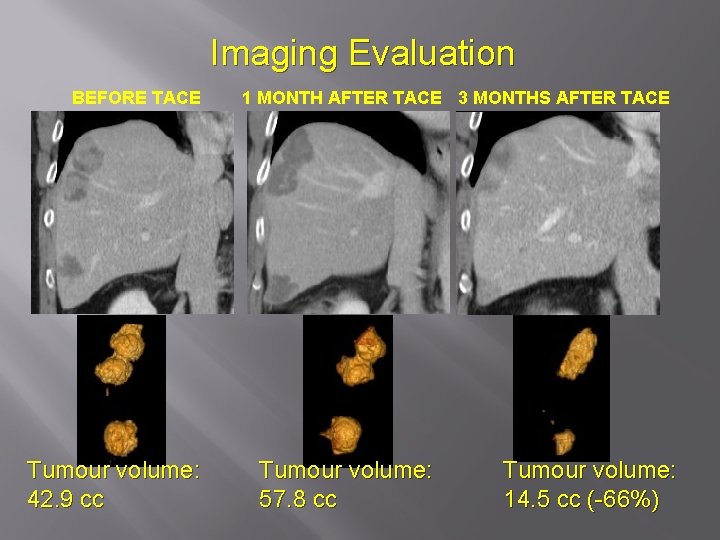 Imaging Evaluation BEFORE TACE Tumour volume: 42. 9 cc 1 MONTH AFTER TACE 3