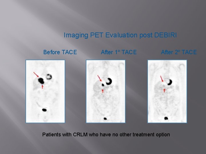 Imaging PET Evaluation post DEBIRI Before TACE After 1º TACE After 2º TACE Patients
