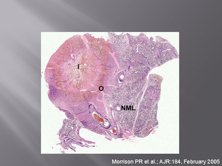 Morrison PR et al. ; AJR: 184, February 2005 