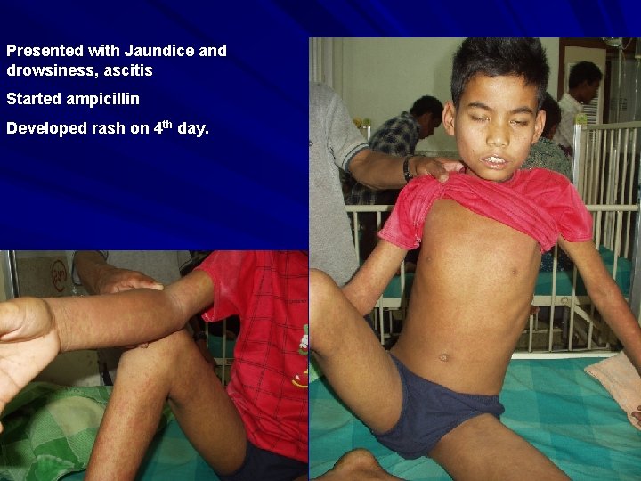 Presented with Jaundice and drowsiness, ascitis Started ampicillin Developed rash on 4 th day.