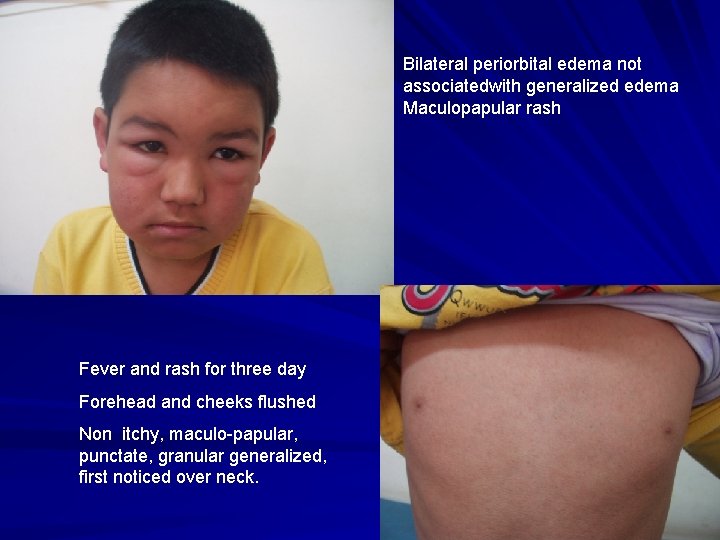 Bilateral periorbital edema not associatedwith generalized edema Maculopapular rash Fever and rash for three