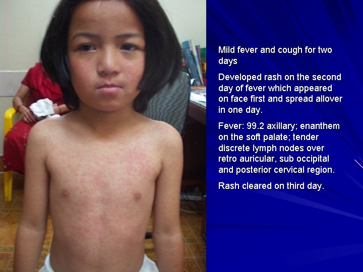 Mild fever and cough for two days Developed rash on the second day of