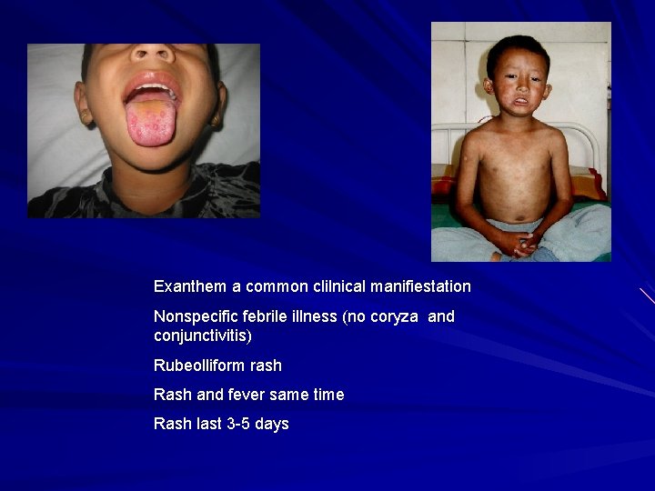 Exanthem a common clilnical manifiestation Nonspecific febrile illness (no coryza and conjunctivitis) Rubeolliform rash