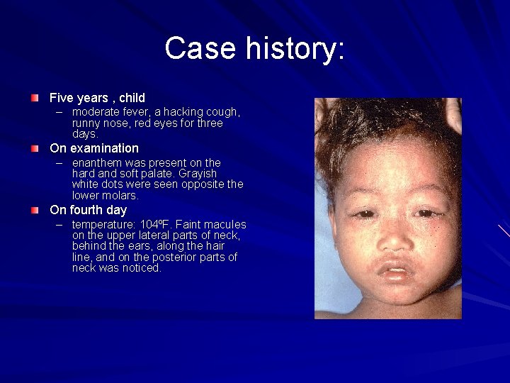 Case history: Five years , child – moderate fever, a hacking cough, runny nose,