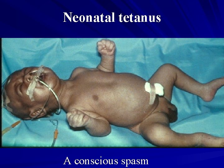 Neonatal tetanus A conscious spasm 