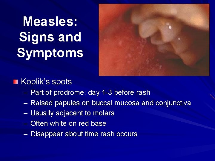 Measles: Signs and Symptoms Koplik’s spots – – – Part of prodrome: day 1