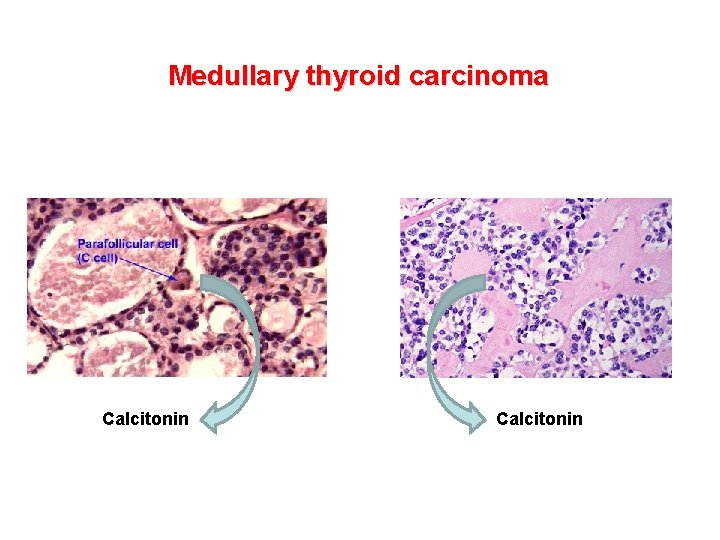 Medullary thyroid carcinoma Calcitonin 