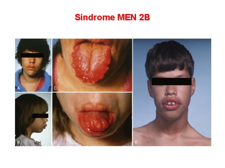 Sindrome MEN 2 B 