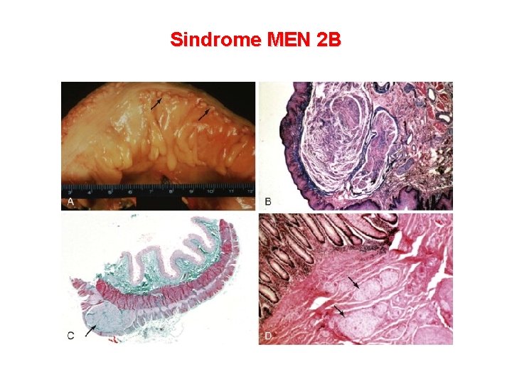 Sindrome MEN 2 B 
