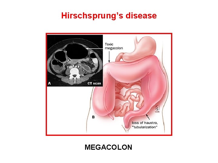 Hirschsprung’s disease MEGACOLON 