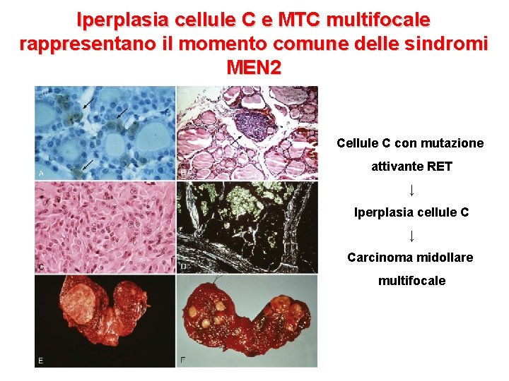 Iperplasia cellule C e MTC multifocale rappresentano il momento comune delle sindromi MEN 2