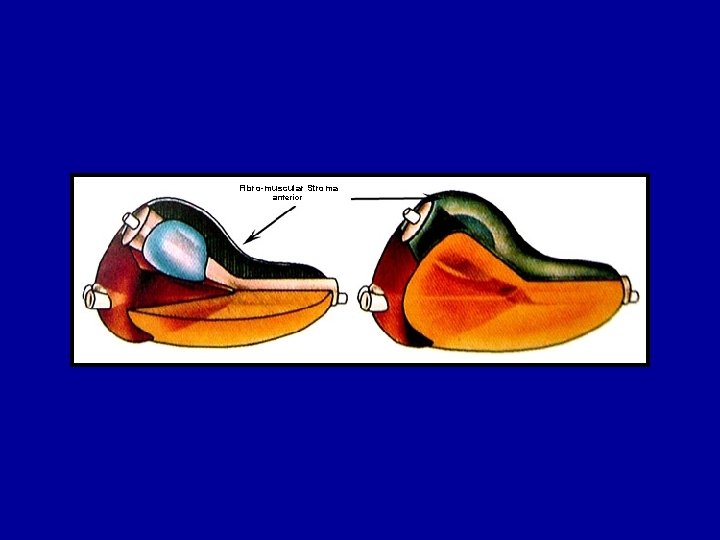 Fibro-muscular Stroma anterior 