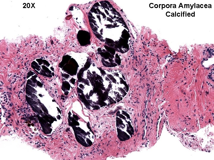 20 X Corpora Amylacea Calcified 