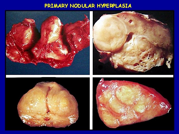 PRIMARY NODULAR HYPERPLASIA 