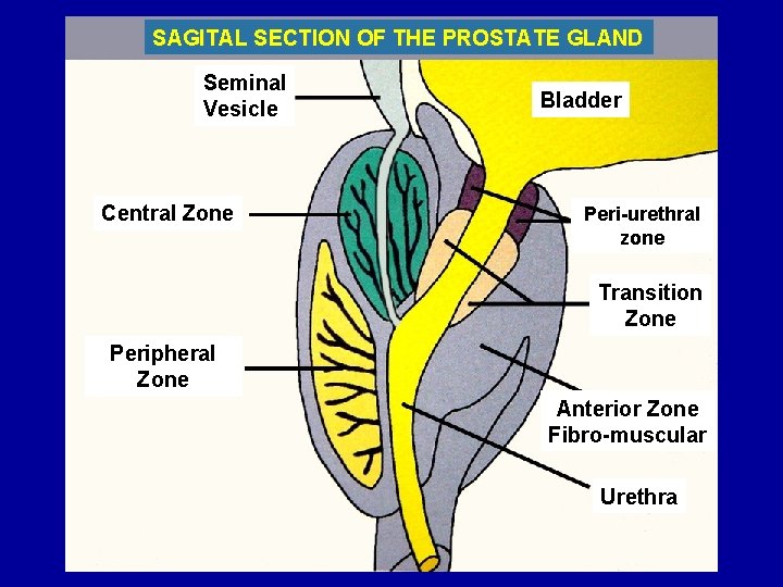 SAGITAL SECTION OF THE PROSTATE GLAND Seminal Vesicle Central Zone Bladder Peri-urethral zone Transition