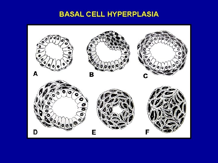 BASAL CELL HYPERPLASIA 