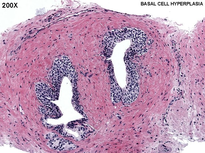 200 X BASAL CELL HYPERPLASIA 