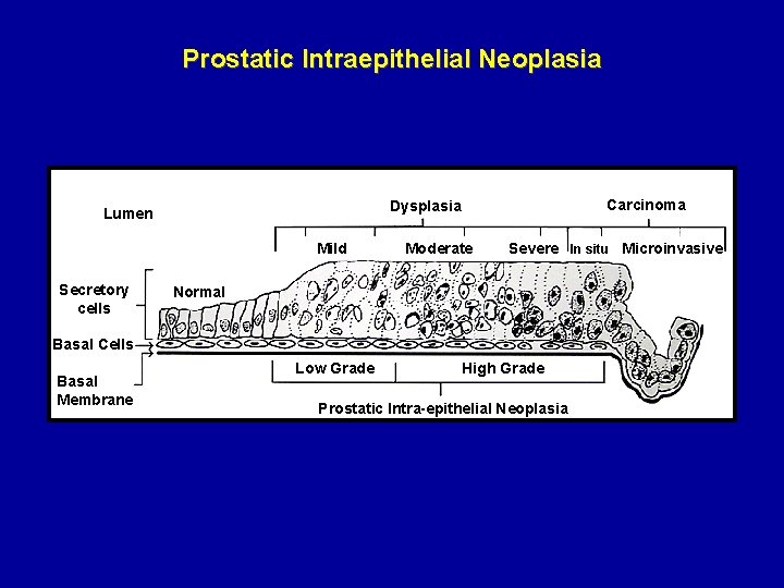 Prostatic Intraepithelial Neoplasia Mild Secretory cells Carcinoma Dysplasia Lumen Moderate Severe In situ Microinvasive