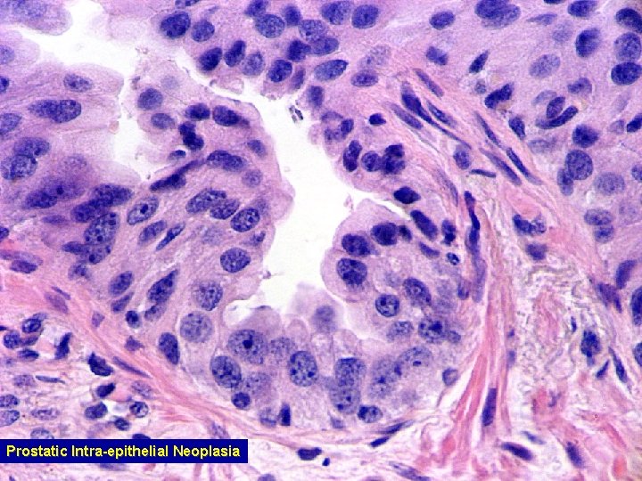 Prostatic Intra-epithelial Neoplasia 