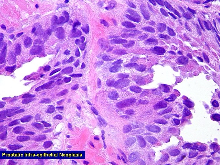 Prostatic Intra-epithelial Neoplasia 