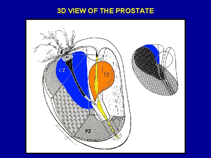 3 D VIEW OF THE PROSTATE 