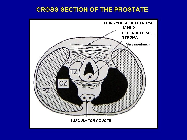 CROSS SECTION OF THE PROSTATE FIBROMUSCULAR STROMA anterior PERI-URETHRAL STROMA EJACULATORY DUCTS 