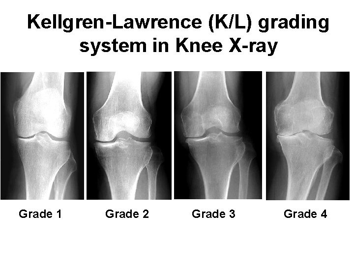 Kellgren-Lawrence (K/L) grading system in Knee X-ray Grade 1 Grade 2 Grade 3 Grade