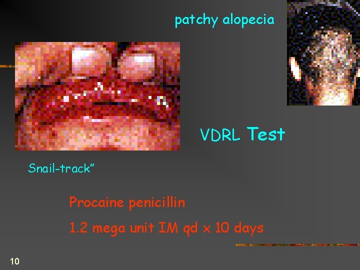 patchy alopecia VDRL Test Snail-track” Procaine penicillin 1. 2 mega unit IM qd x