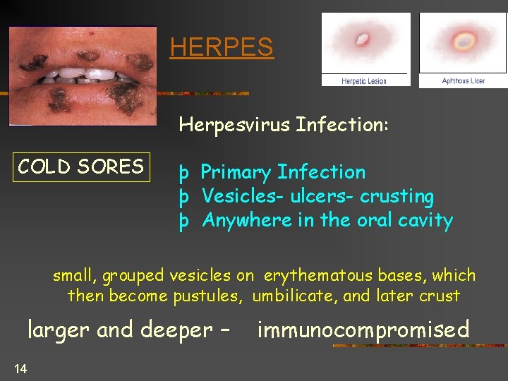 HERPES Herpesvirus Infection: COLD SORES þ Primary Infection þ Vesicles- ulcers- crusting þ Anywhere