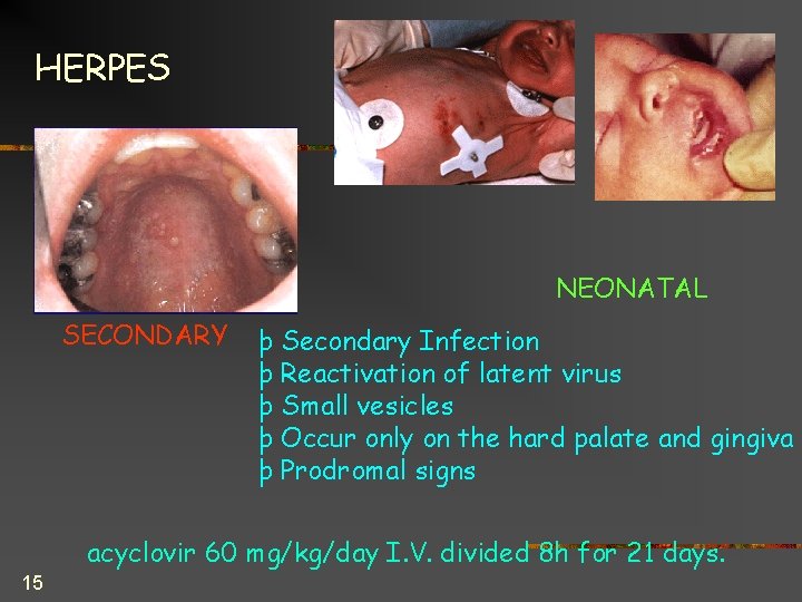 HERPES NEONATAL SECONDARY þ Secondary Infection þ Reactivation of latent virus þ Small vesicles