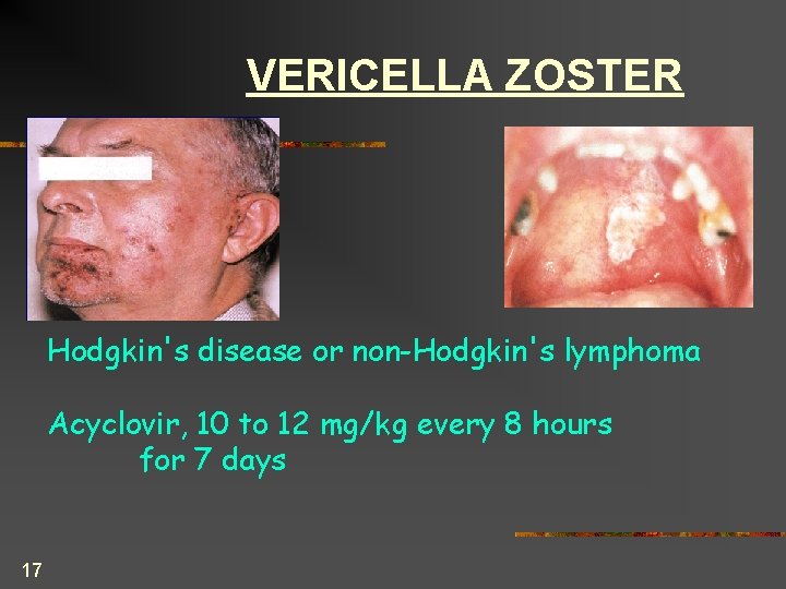 VERICELLA ZOSTER Hodgkin's disease or non-Hodgkin's lymphoma Acyclovir, 10 to 12 mg/kg every 8