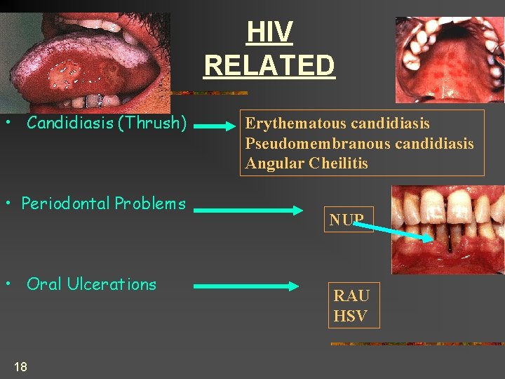 HIV RELATED • Candidiasis (Thrush) • Periodontal Problems • Oral Ulcerations 18 Erythematous candidiasis