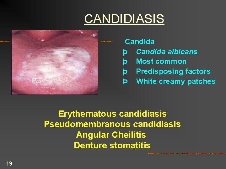 CANDIDIASIS Candida þ Candida albicans þ Most common þ Predisposing factors Þ White creamy
