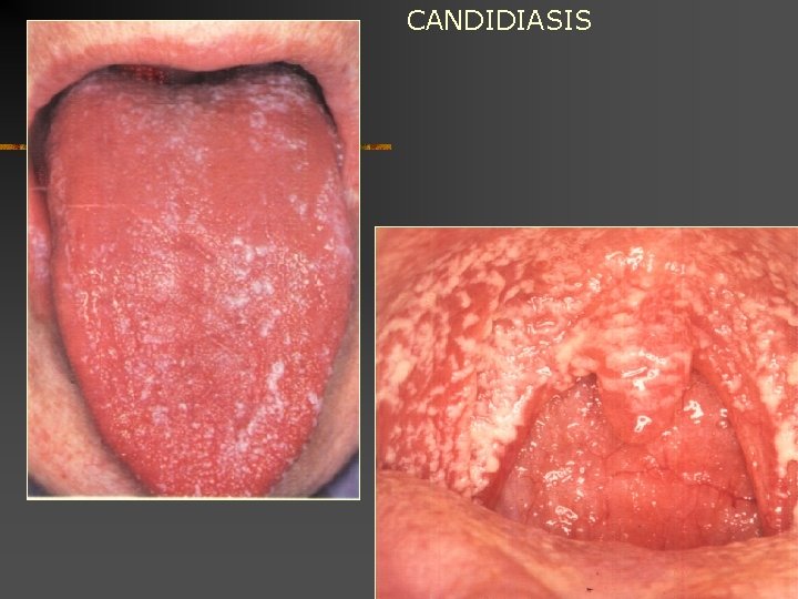 CANDIDIASIS 