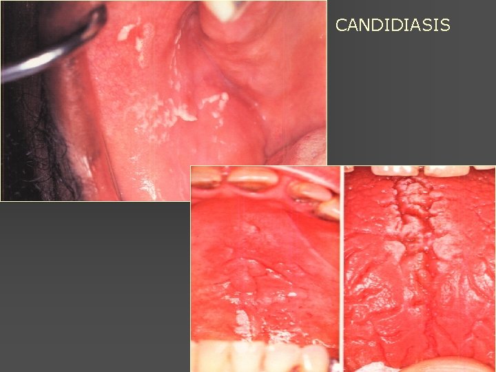 CANDIDIASIS 