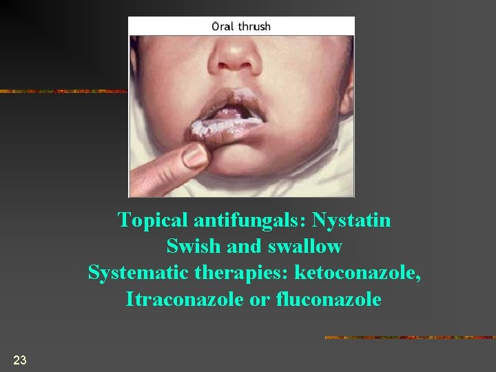 Topical antifungals: Nystatin Swish and swallow Systematic therapies: ketoconazole, Itraconazole or fluconazole 23 