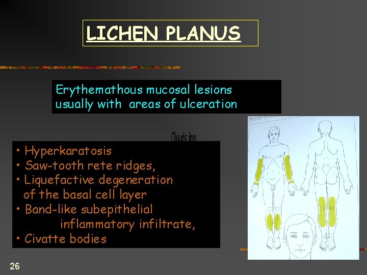 LICHEN PLANUS Erythemathous mucosal lesions usually with areas of ulceration • Hyperkaratosis • Saw-tooth