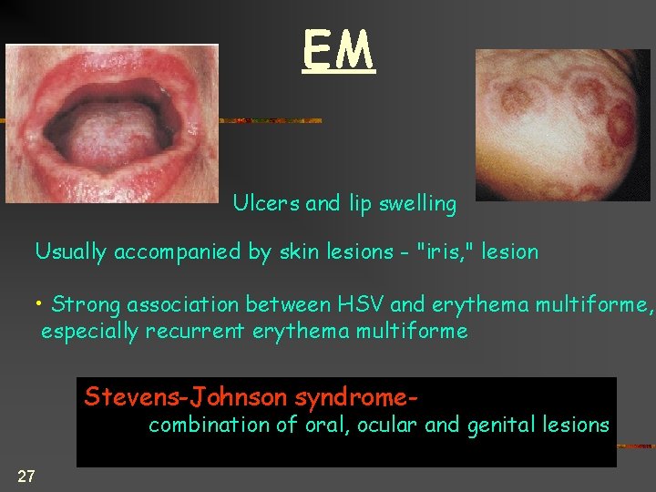 EM Ulcers and lip swelling Usually accompanied by skin lesions - "iris, " lesion