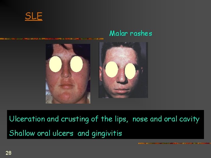 SLE Malar rashes Ulceration and crusting of the lips, nose and oral cavity Shallow