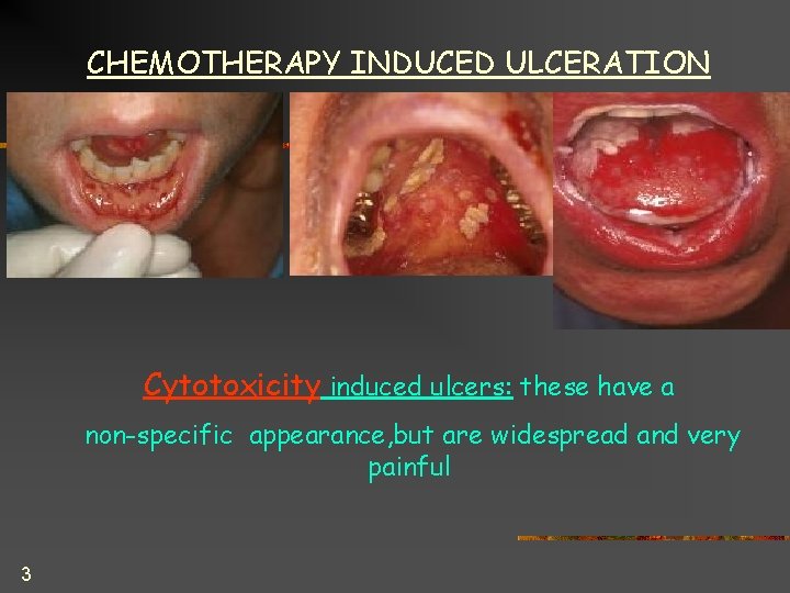 CHEMOTHERAPY INDUCED ULCERATION Cytotoxicity induced ulcers: these have a non-specific appearance, but are widespread