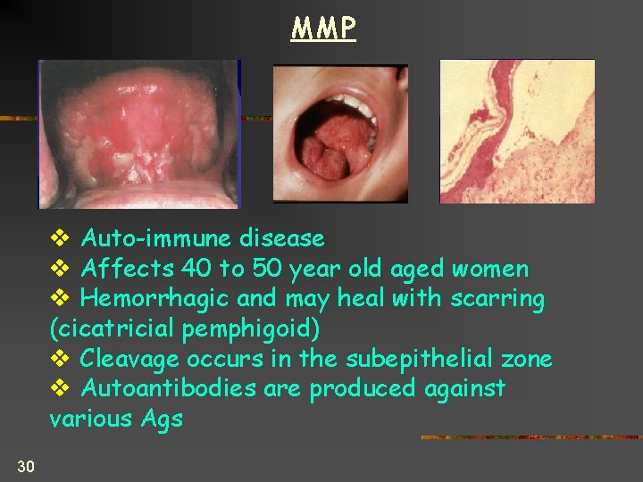 MMP v Auto-immune disease v Affects 40 to 50 year old aged women v