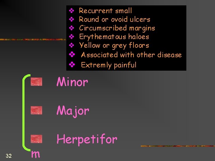 Recurrent small Round or ovoid ulcers Circumscribed margins Erythematous haloes Yellow or grey floors