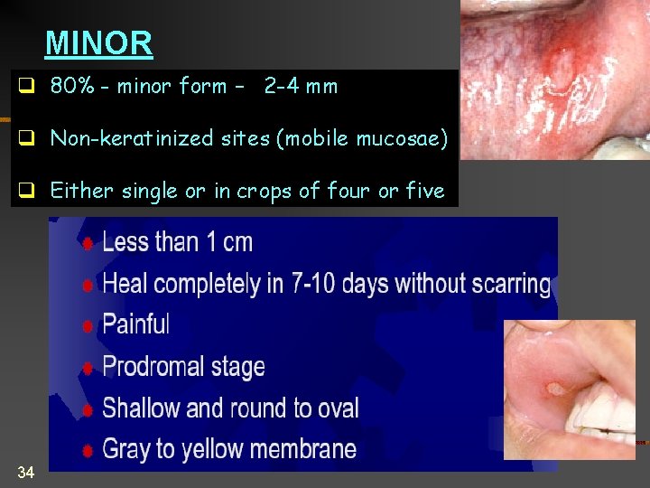 MINOR q 80% - minor form – 2 -4 mm q Non-keratinized sites (mobile