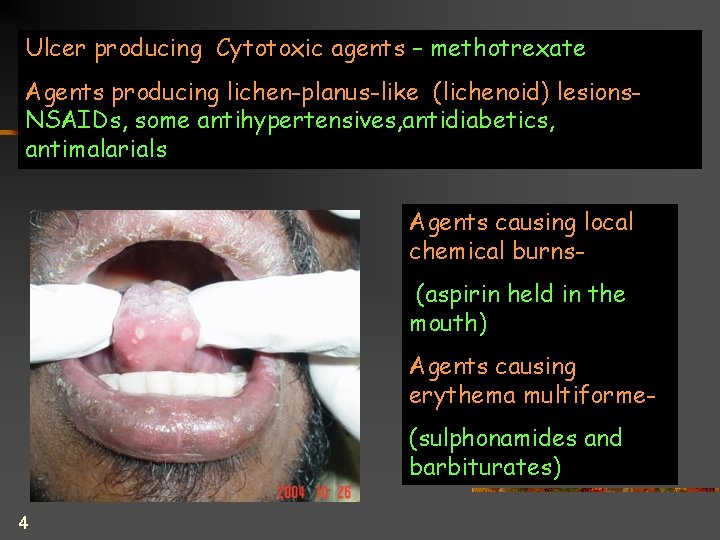 Ulcer producing Cytotoxic agents – methotrexate Agents producing lichen-planus-like (lichenoid) lesions. NSAIDs, some antihypertensives,