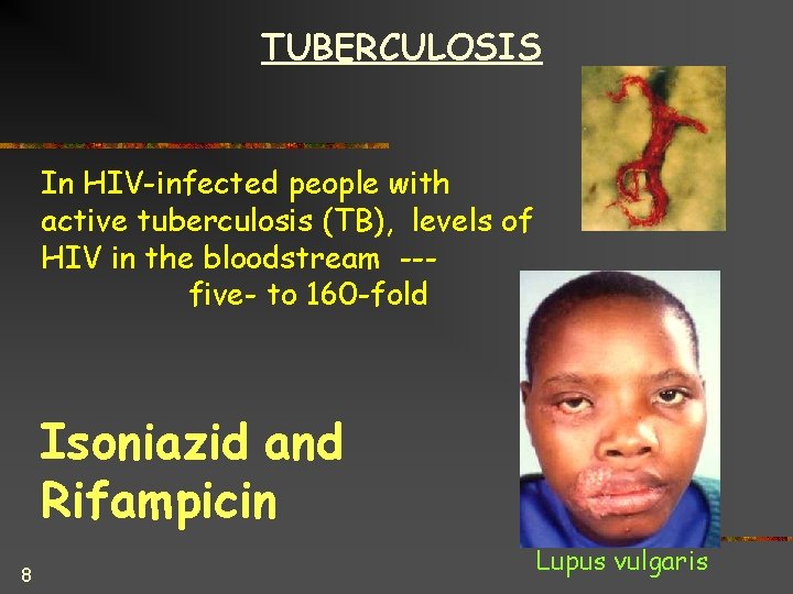 TUBERCULOSIS In HIV-infected people with active tuberculosis (TB), levels of HIV in the bloodstream