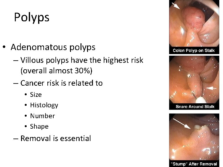 Polyps • Adenomatous polyps – Villous polyps have the highest risk (overall almost 30%)
