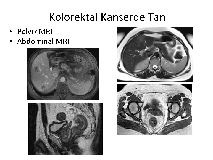 Kolorektal Kanserde Tanı • Pelvik MRI • Abdominal MRI 