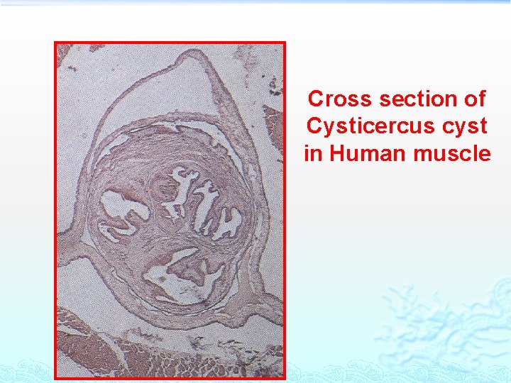 Cross section of Cysticercus cyst in Human muscle 