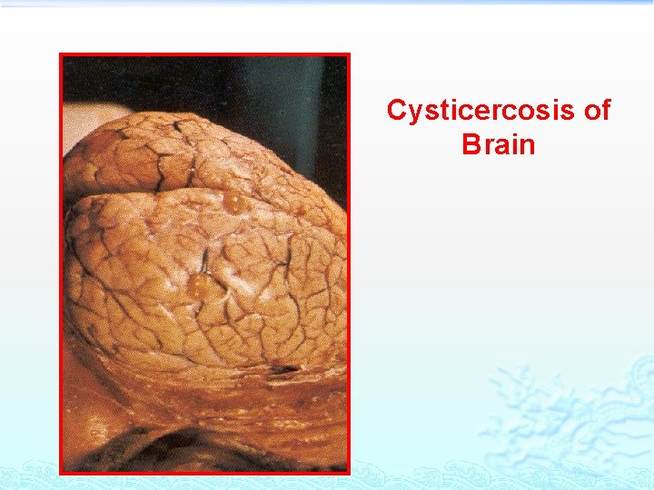 Cysticercosis of Brain 