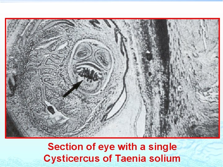 Section of eye with a single Cysticercus of Taenia solium 